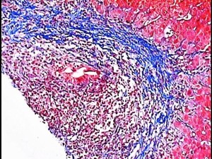 Masson en una biopsia de hígado
