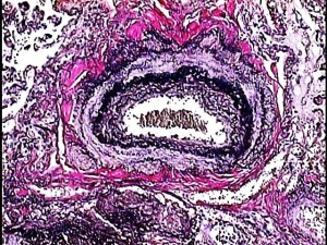 Tinción de fibras elásticas, que muestra una arteria de una biopsia de pulmón